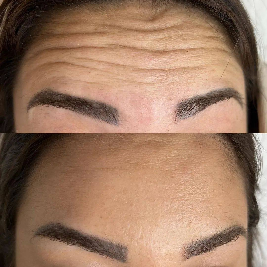 A before-and-after comparison of a woman's forehead showing reduction of wrinkles and smoother skin after cosmetic treatment.