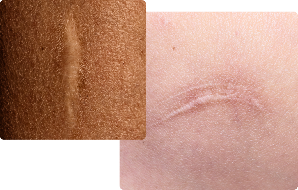 Close-up comparison of skin with stretch marks