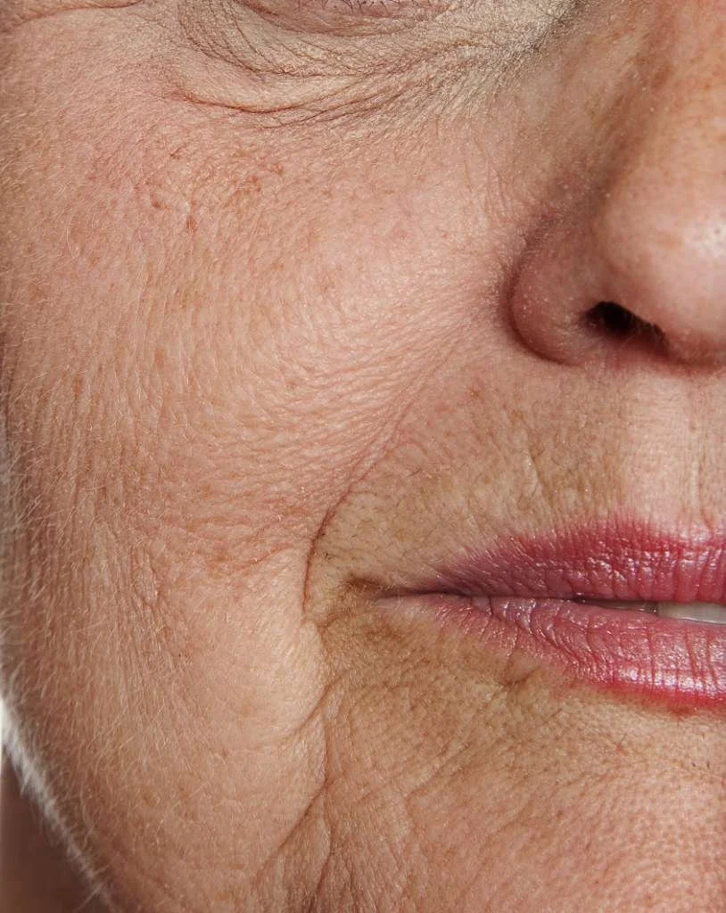 Close-up of a person's face showing the cheek, nose, and lips with visible skin texture and fine lines.