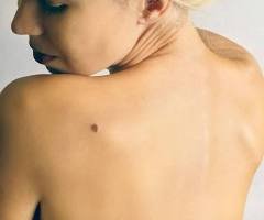 Close-up of a person's bare back with a small mole.