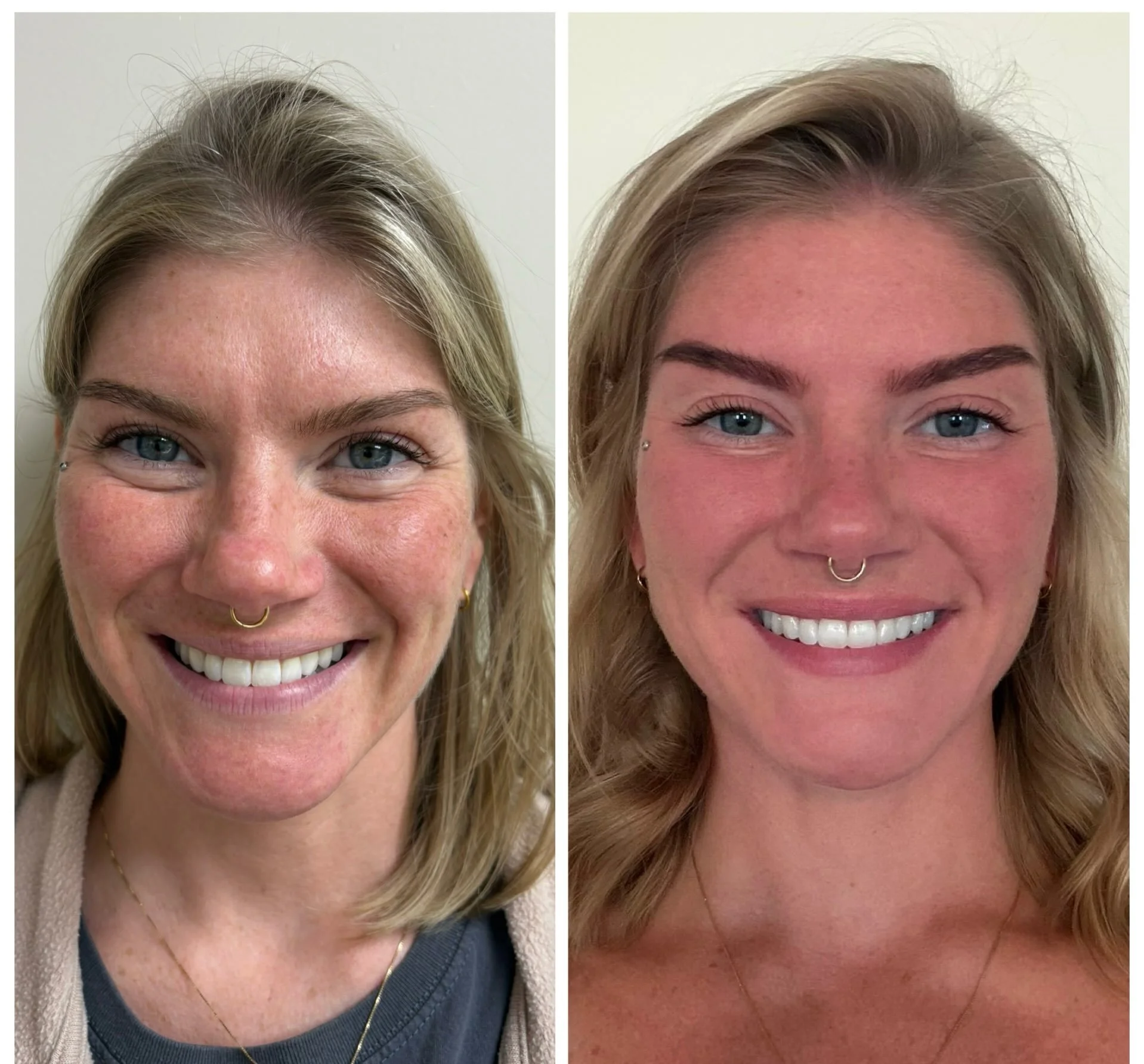 Full-face refresh, subtle results. ✨

This beautiful transformation included Dysport in the following areas:
💉 Forehead
💉 Glabella (frown lines)
💉 Crow&rsquo;s feet
💉 Lip flip
💉 Jelly roll (under eye)
💉 Nefertiti Lift

The goal isn&rsquo;t to l