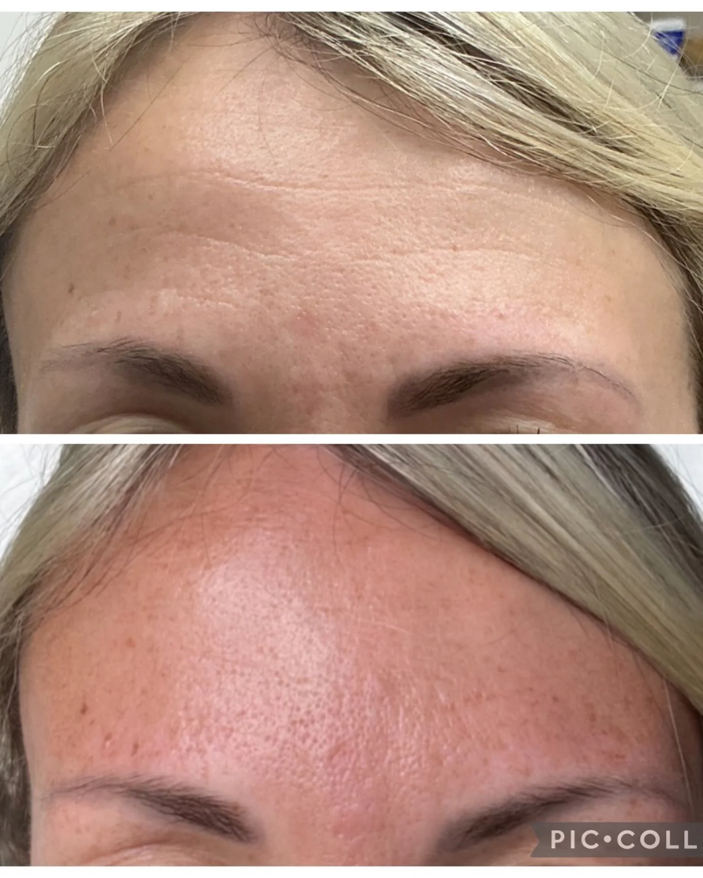 Forehead refresh ✨

Smooth doesn&rsquo;t have to mean frozen. A few strategically placed units can soften forehead lines while keeping your natural expressions intact.

📅 Ready to refresh your look? Book your consultation today 
330-635-0883