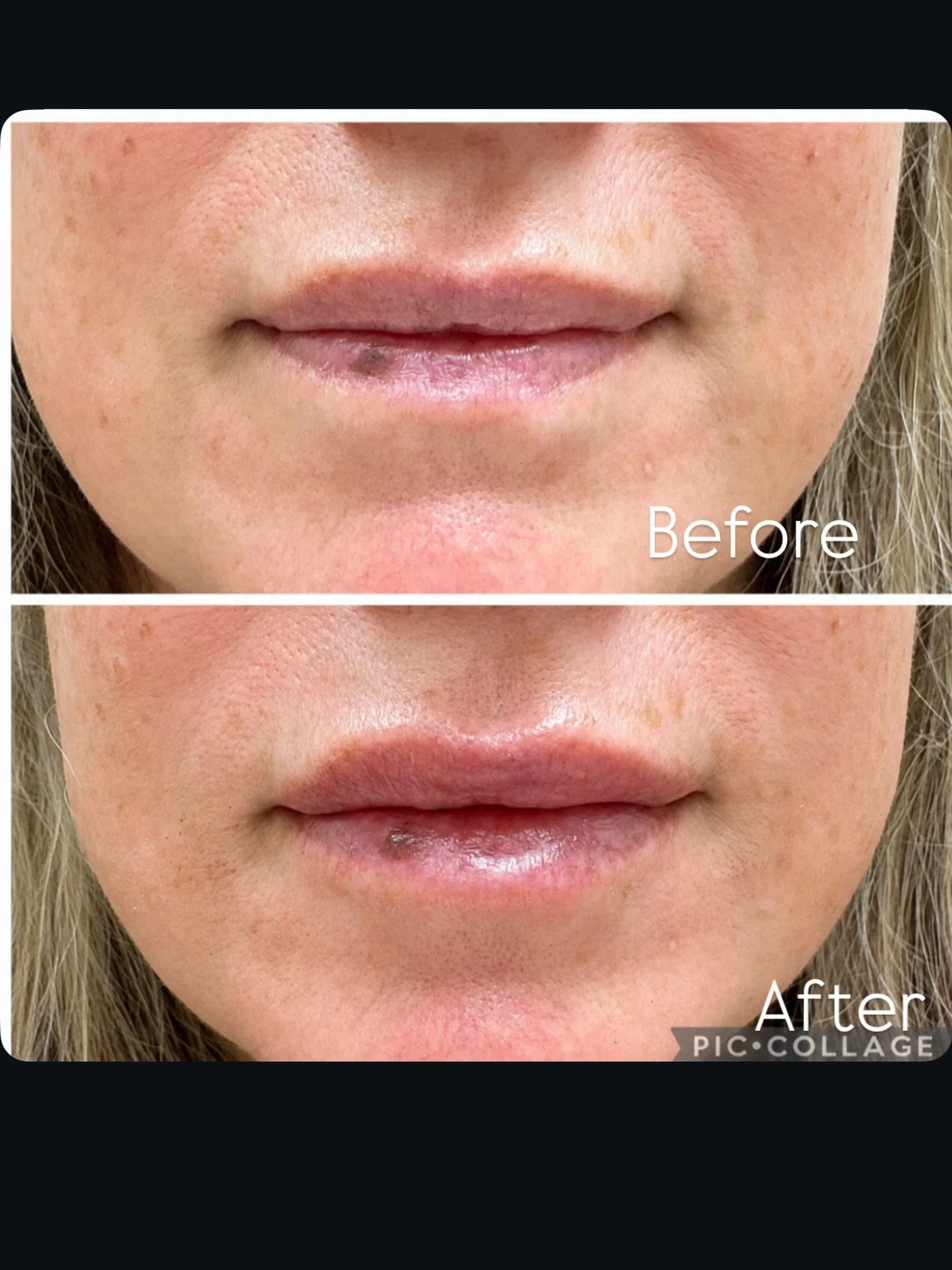 💋 Lip Filler Friday 💋

Curious what lip filler can help with? 👄

✨ Enhance lip shape
✨ Add subtle volume
✨ Improve symmetry
✨ Restore hydration and definition

This beautiful result was achieved with Revanesse Versa&mdash;for a natural, refreshed 