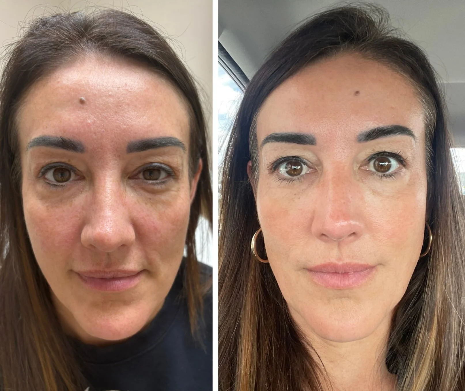 Sculptra + Dysport = ✨

A beautiful example of a natural-looking refresh after 2 sessions of Sculptra + Dysport to the forehead, glabella, crow&rsquo;s feet &amp; under eye.

We&rsquo;re seeing smoother skin, softened expression lines and an overall 