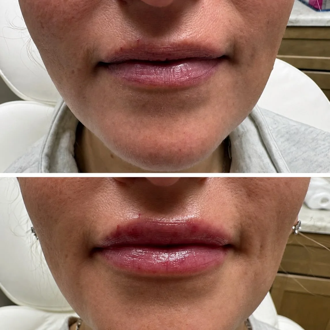 The kind of lip filler that makes you look in the mirror a little longer. 💋✨

If you&rsquo;ve been thinking about enhancing your lips, this is your sign.
DM us to book your consultation or 
Call/text 330-635-0883
