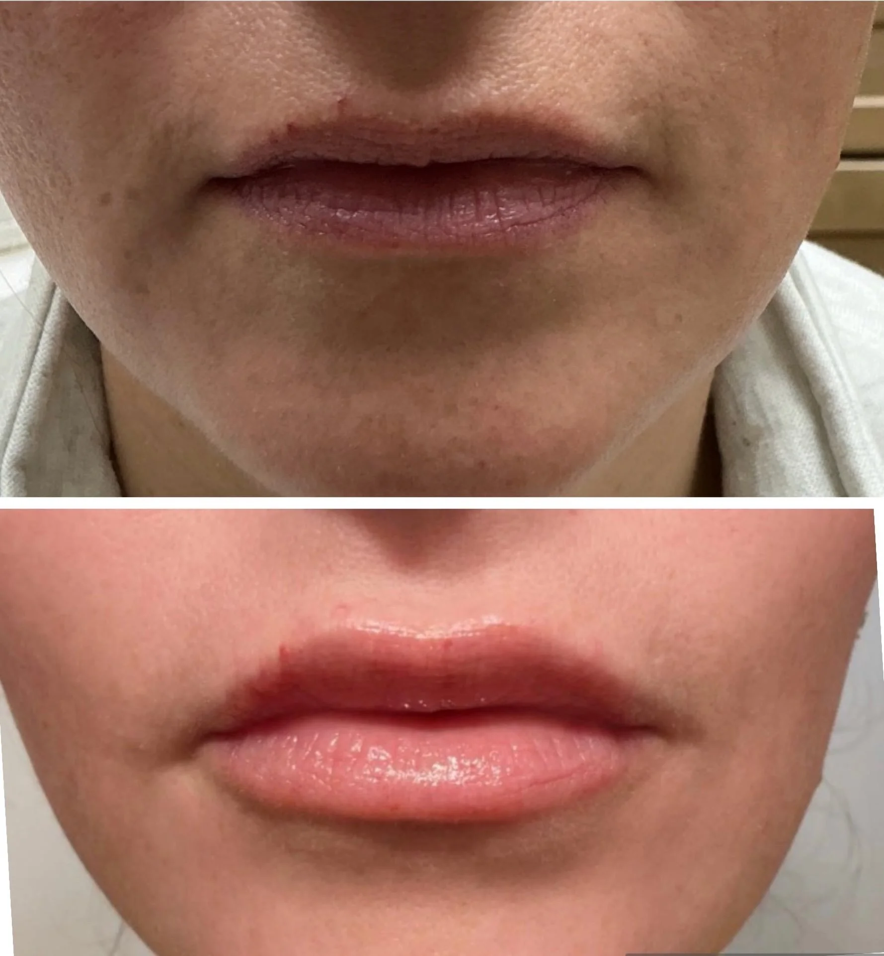 Okay&hellip; but LOOK at those lips. 👀💋
A beautiful boost of volume + definition while keeping everything soft and natural.

Let&rsquo;s chat about your lip goals. 💋
DM us to book!