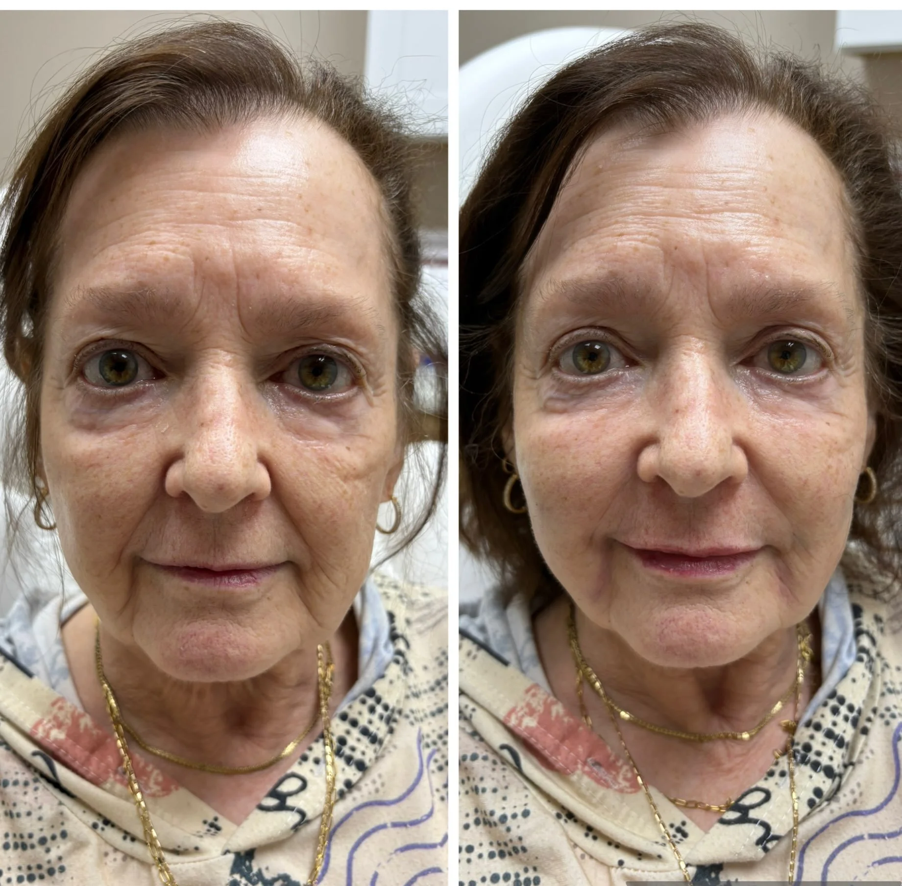 Before ➡️ After ✨

A combination approach using dermal filler in the nasolabial folds, marionette lines &amp; lips, plus Sculptra to support collagen production over time.

It&rsquo;s not about changing your face &mdash; it&rsquo;s about restoring wh