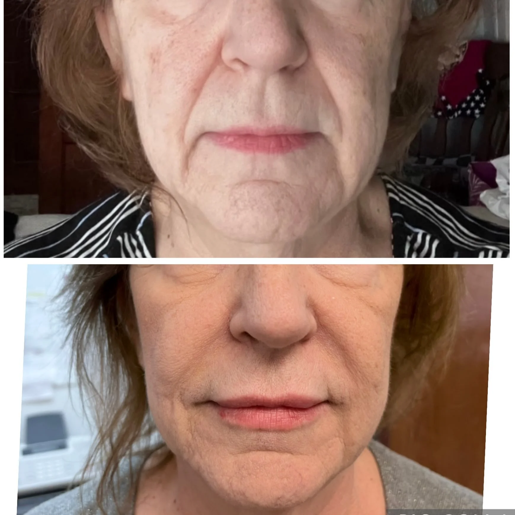 ✨ A little filler, a lot of difference.

This before &amp; after features lip + nasolabial fold filler to restore volume, soften folds, and create a more balanced, refreshed appearance. 💉✨

Ready to see what filler could do for you?
📲 DM, call/text