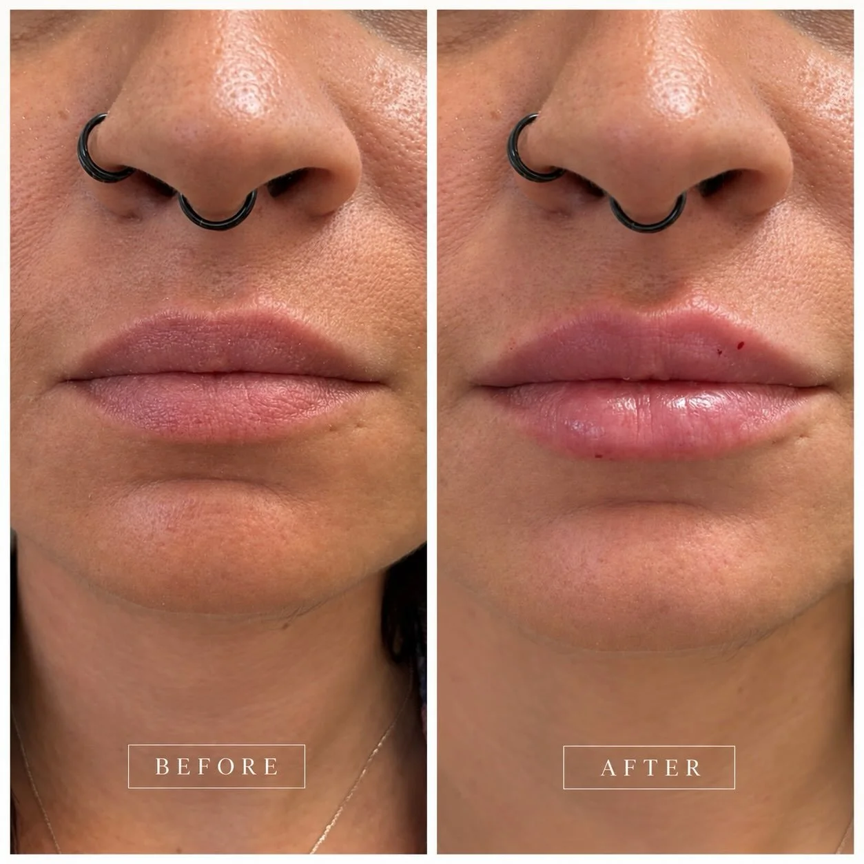We love a good before &amp; after 😍💋

Stunning lip transformation using JUV&Eacute;DERM&reg; Ultra XC &mdash; adding subtle volume along with shape + definition while keeping her results natural-looking.