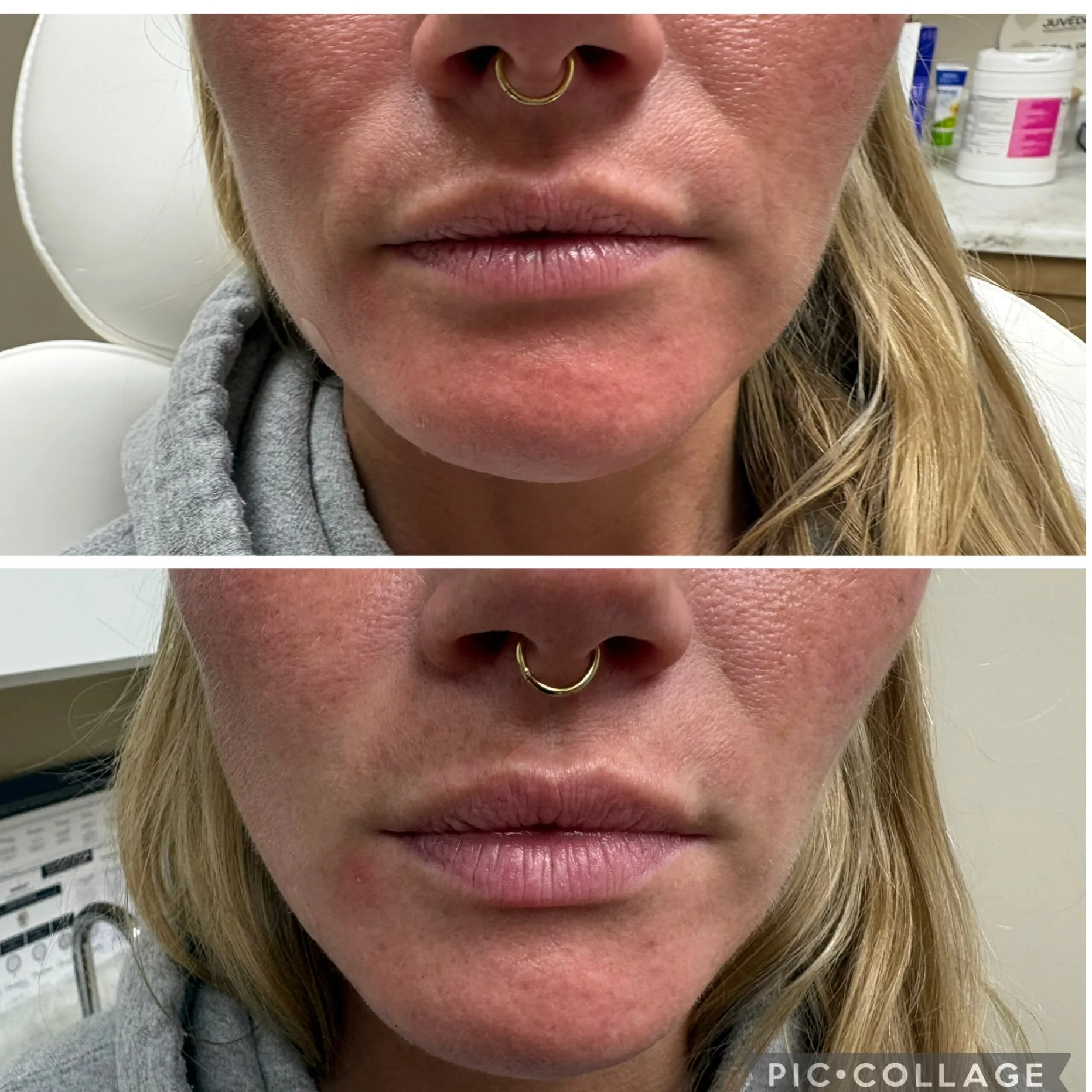 Subtle, soft, and so pretty. 💋 Natural-looking lip enhancement with Versa 😍

DM to book ❤️