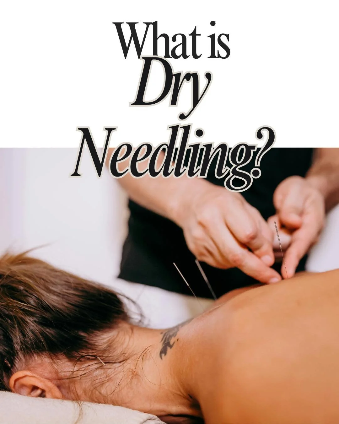 ✨What is Dry Needling?✨

Dry needling is a gentle way to help tight, overworked muscles finally soften and release.
Using super-fine needles, we ease muscle tension, calm the nervous system, and support better movement &mdash; always at your pace.
A 