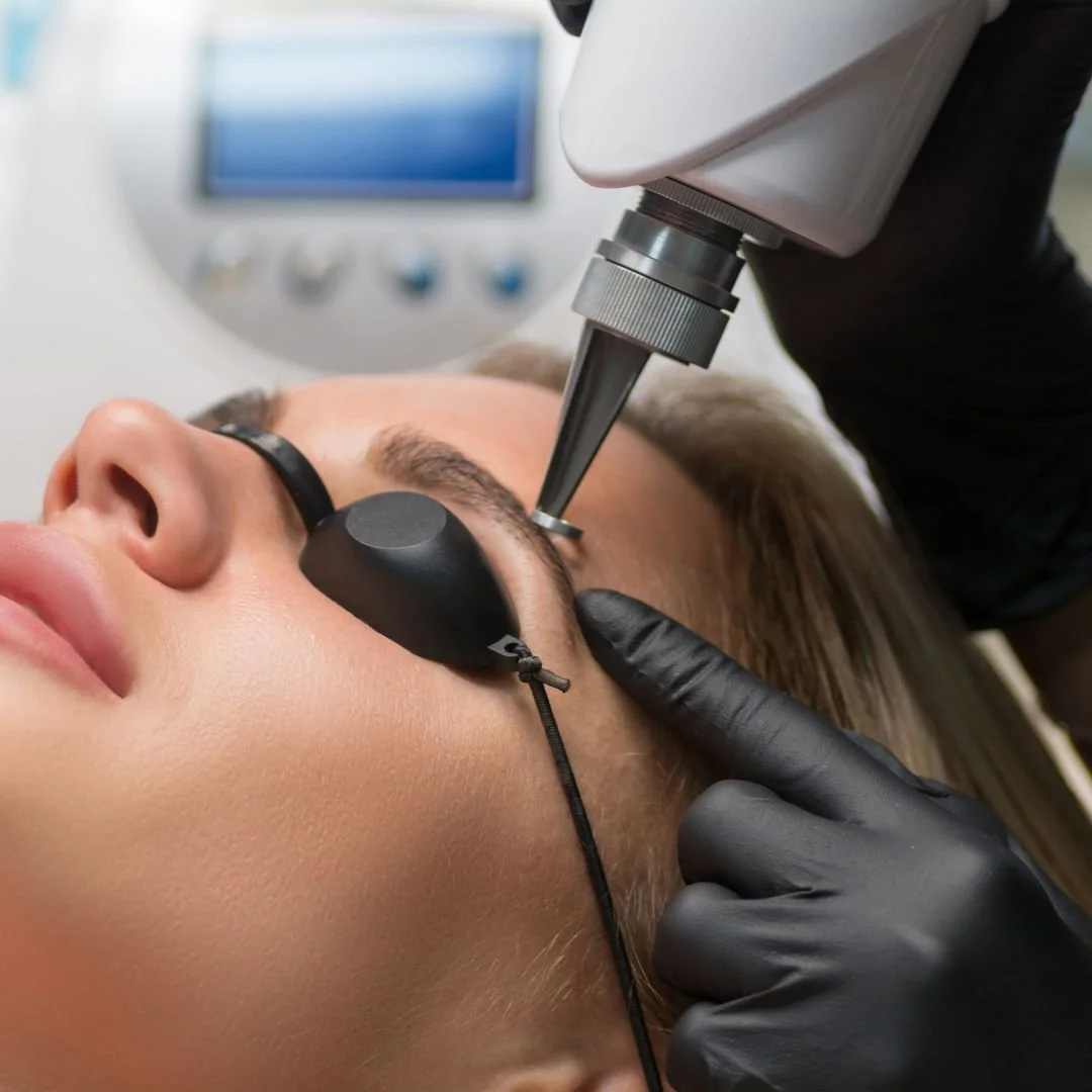 Eliminación de micropigmentación de cejas