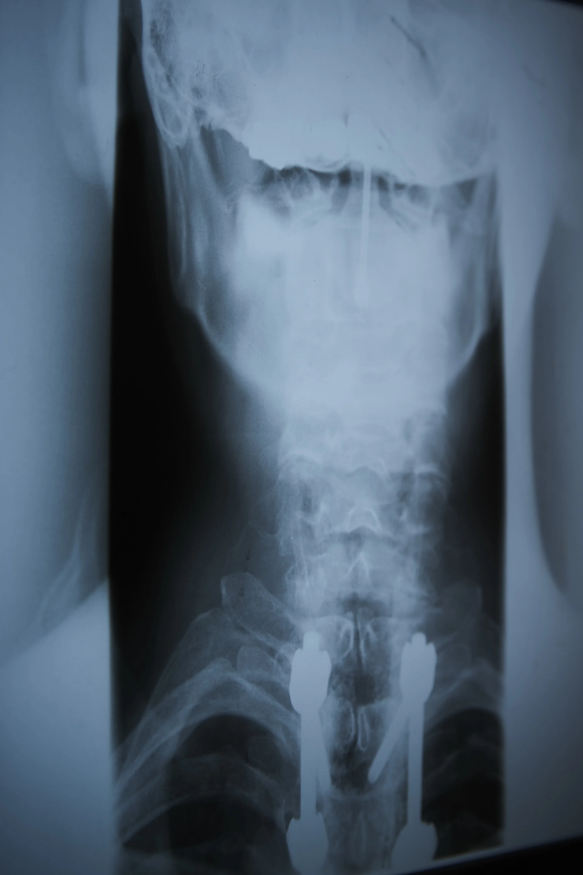 Röntgenaufnahme der Halswirbelsäule mit chirurgischen Implantaten.