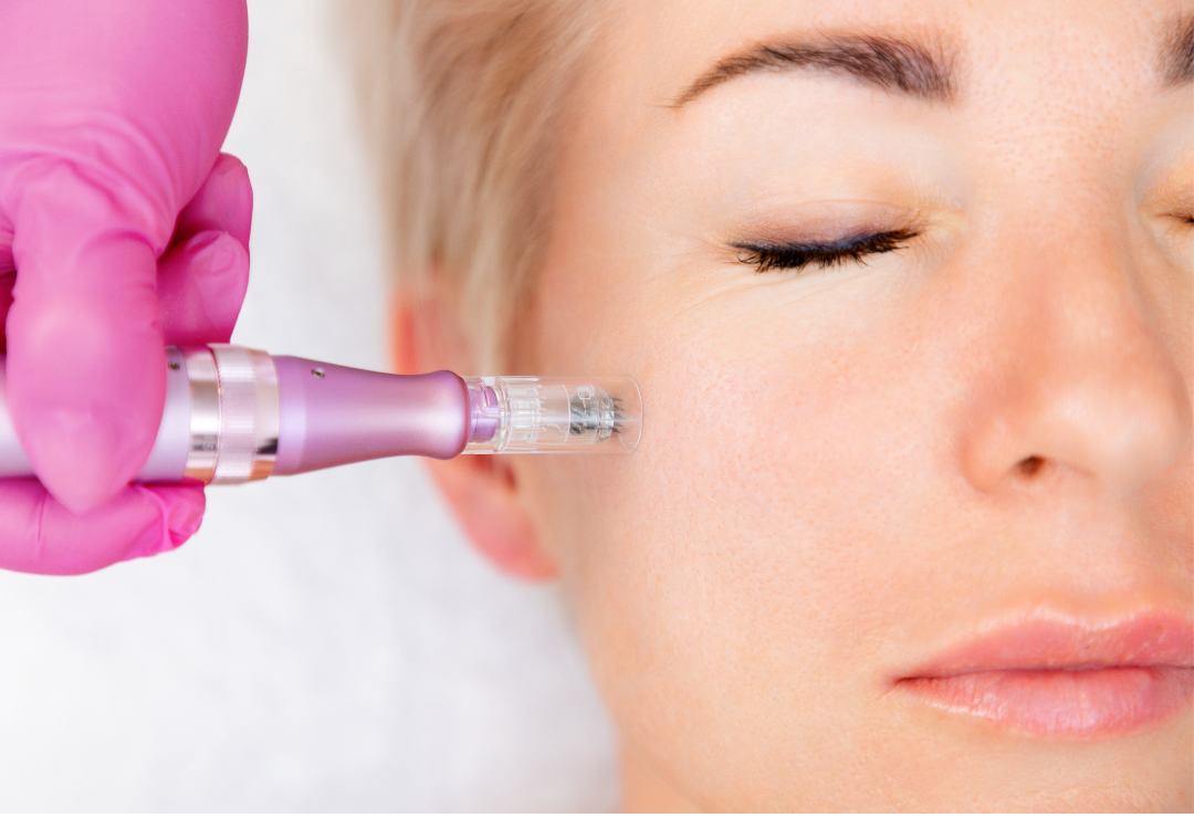 Medspa in Liberty Hill, TX, 78642 | Microneedling with Exosome Near Me