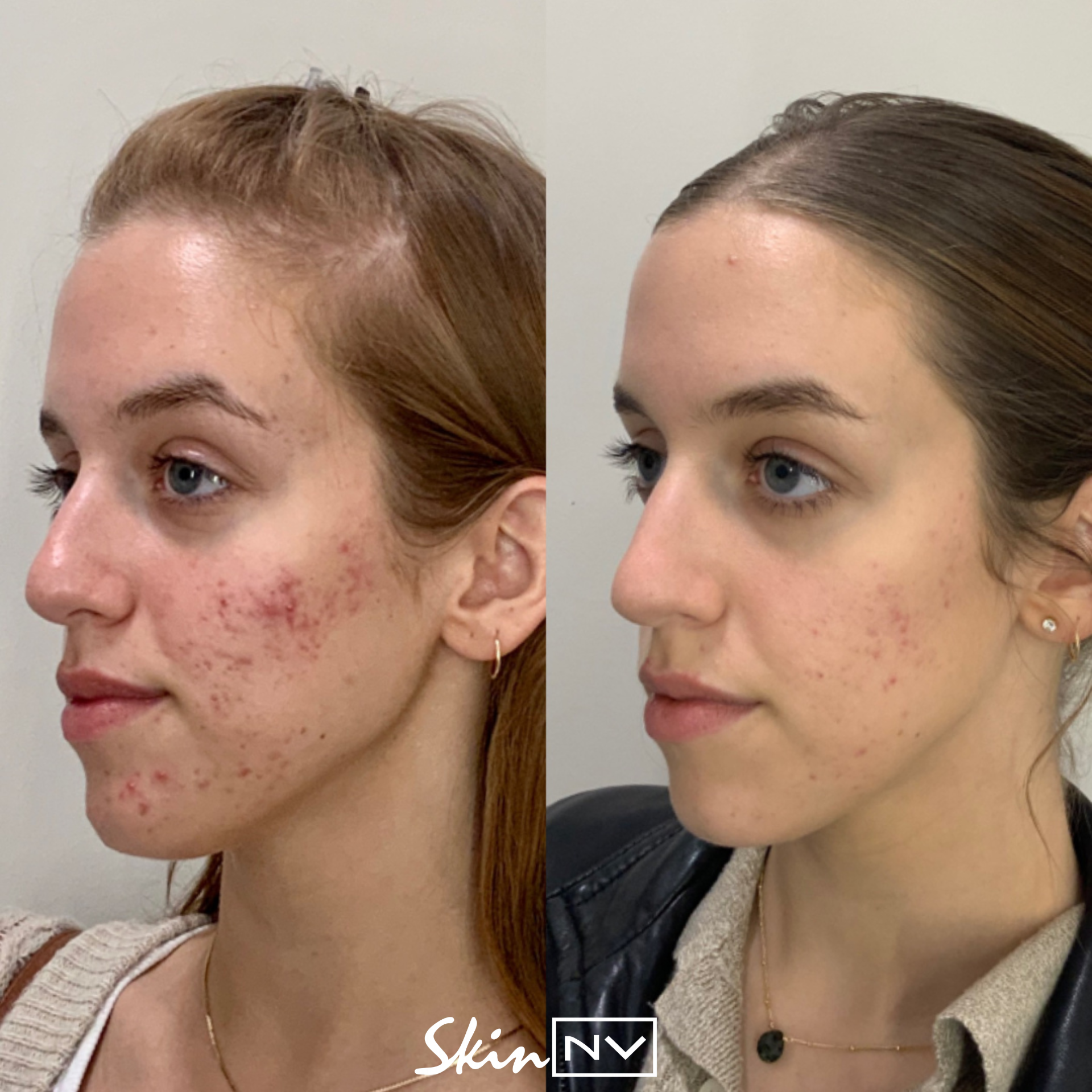 Microneedling | Enhance Your Skin Now — Skin NV