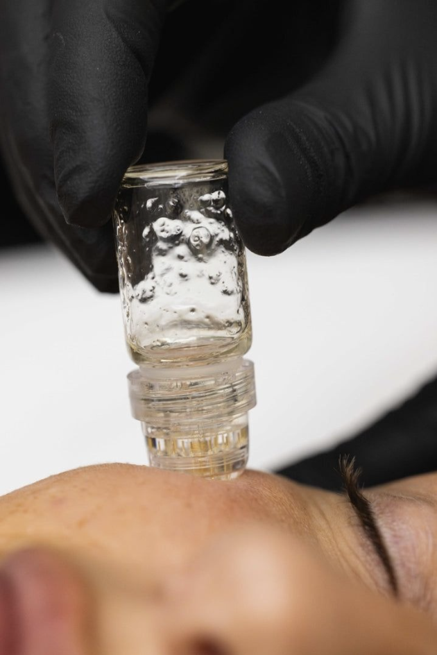 Microinfusion Facial