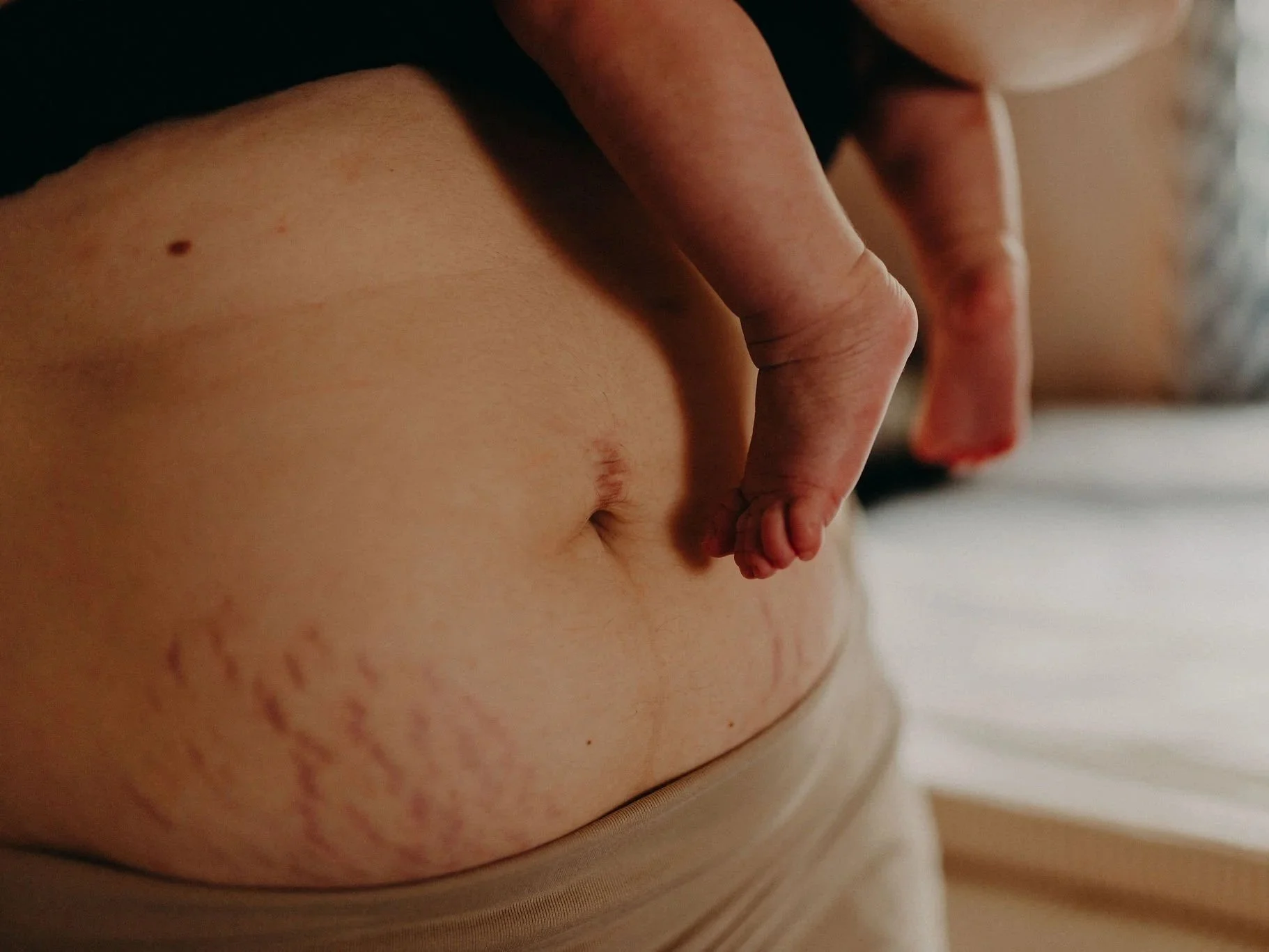 Close up of a white person's midsection. They are holding a white newborn baby who's legs are visible. The adult person has stretch marks on their belly indicating that they are recently postpartum.