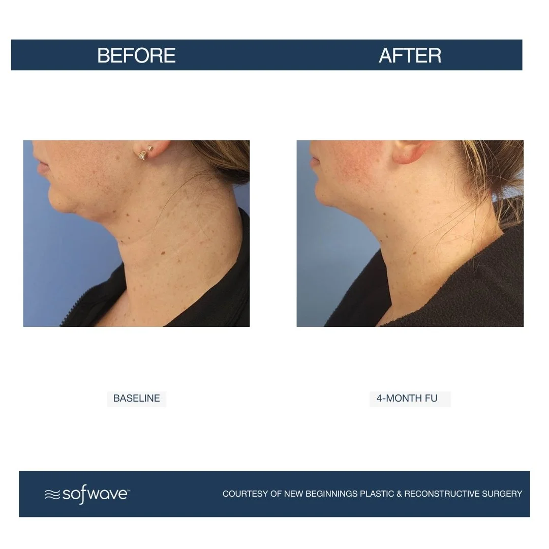 Submental - Sofwave before and after​.jpg