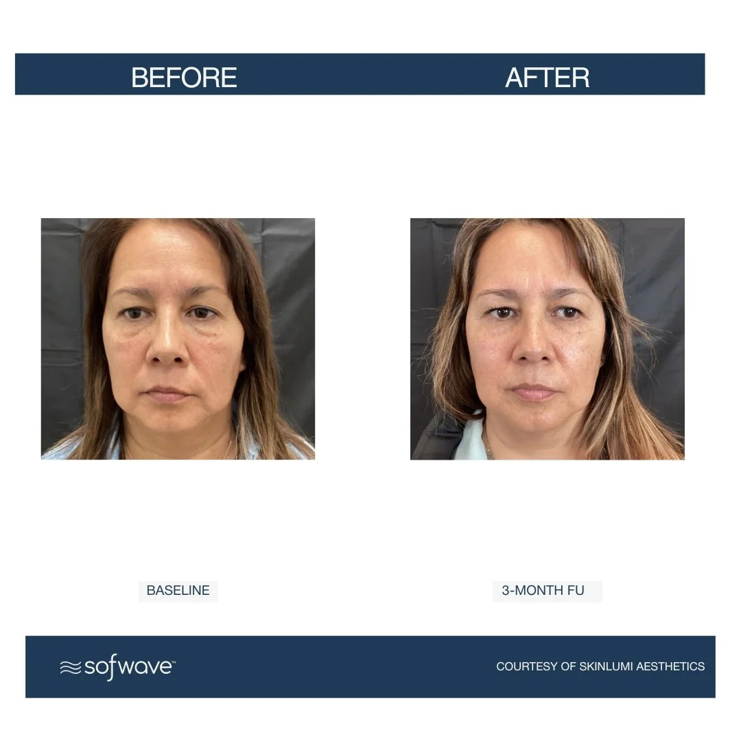 Full-Face - Sofwave before and after​.jpg