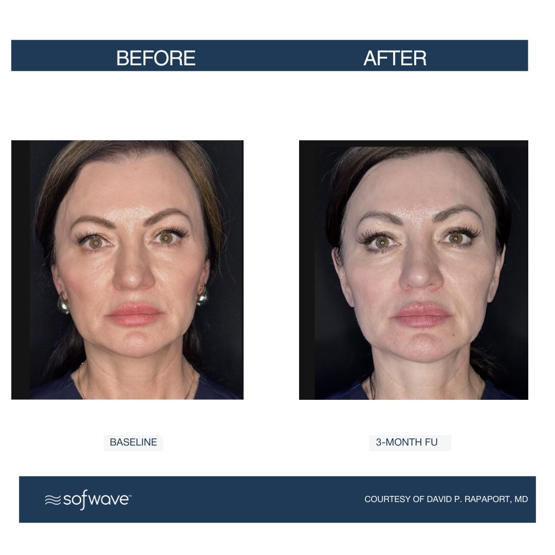 Face-Submental - Sofwave before and after​.jpg
