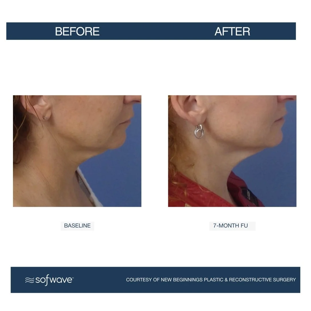 Neck-Submental (2) - Sofwave before and after​.jpg