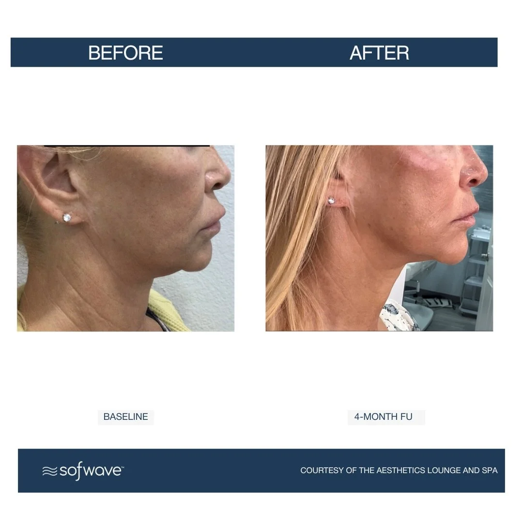 Neck Submental - Sofwave before and after​.jpg