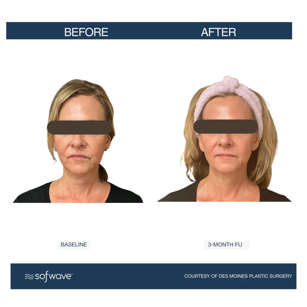 Face-Neck 2 - Sofwave before and after​.jpg