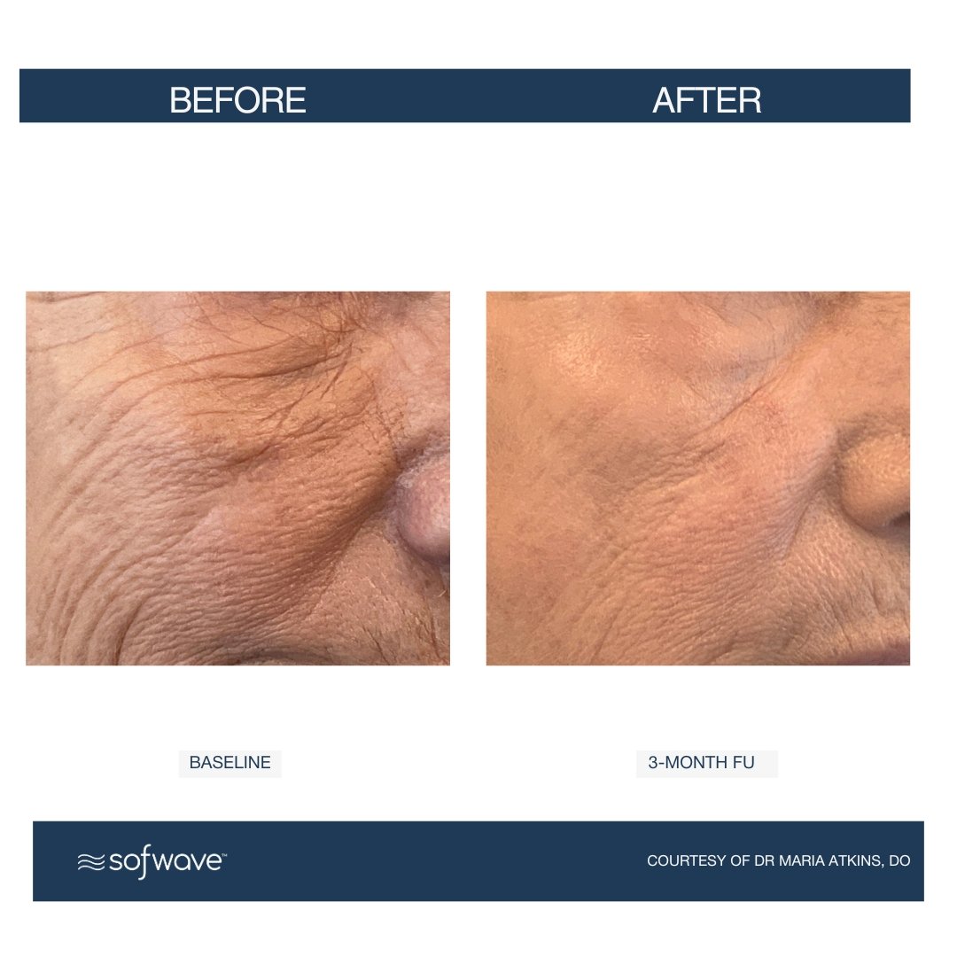 Under-Eyes - Sofwave before and after​.jpg