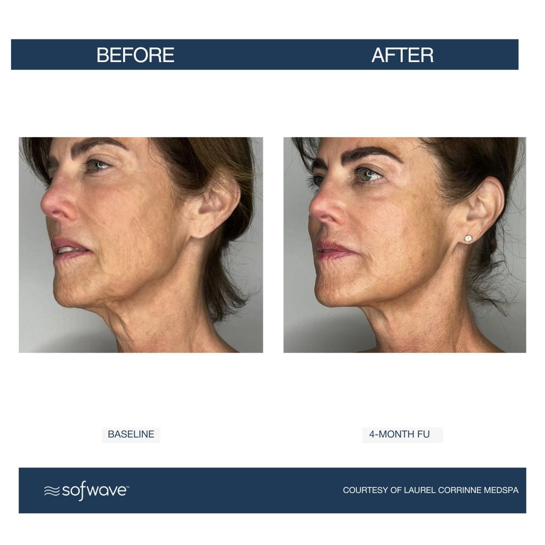 Face-Neck - Sofwave before and after​.jpg