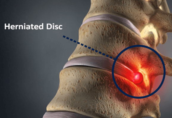 Herniated Discs After a Car Accident: Causes, Symptoms &amp; Treatment