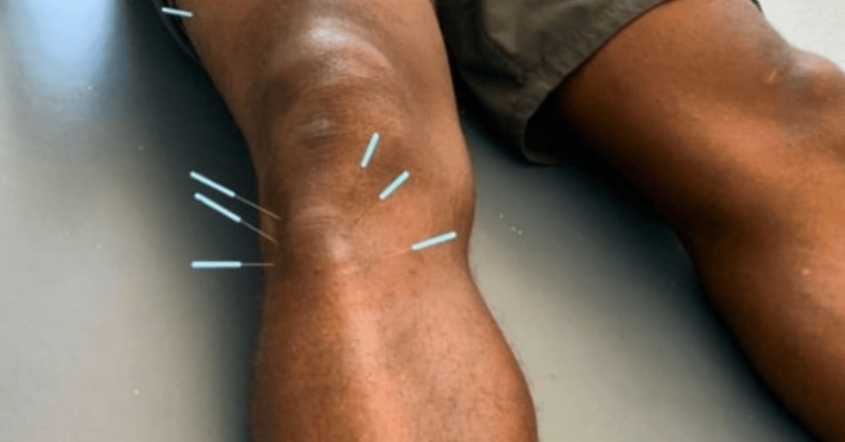 Dry Needling for Chronic Muscle Tightness and Pain in San Antonio