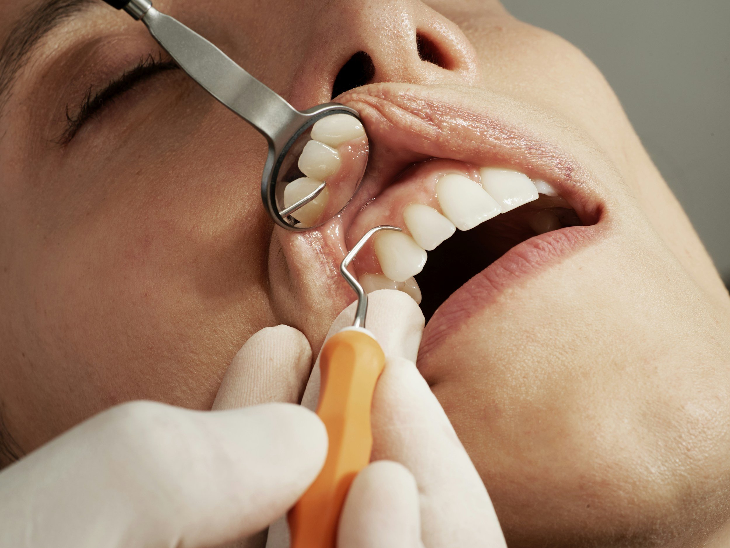 A person receiving dental treatment, with a dentist using a mirror and dental scaler on their upper teeth.