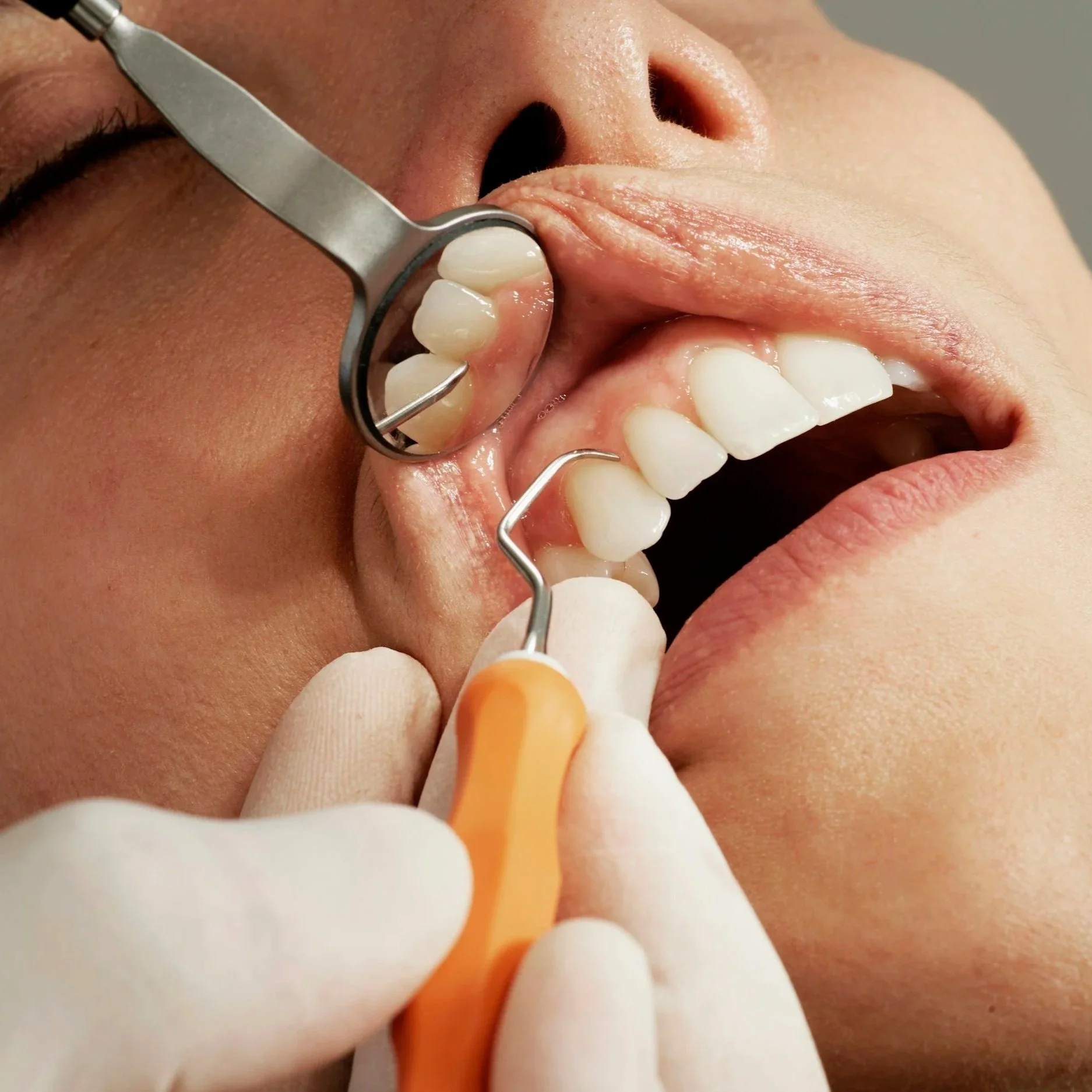 Close-up of a person’s mouth during a dental examination, with dental tools inspecting their teeth.