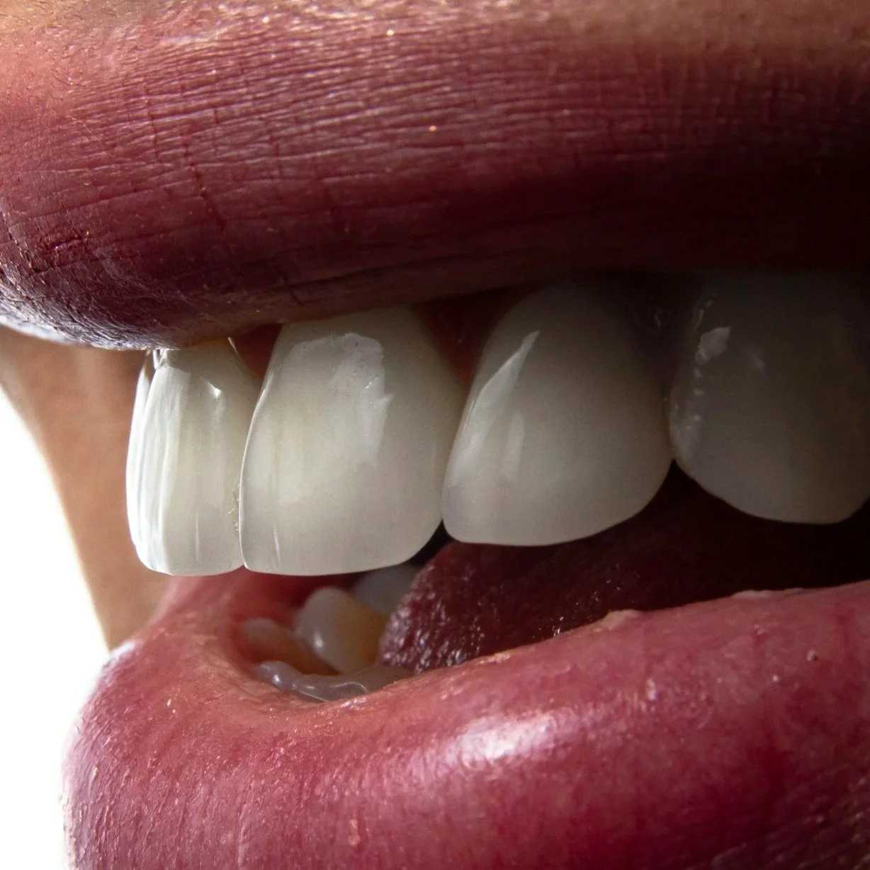 Close-up of a person's open mouth showing bright, clean front teeth.