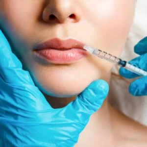 JUVÉDERM® ULTRA +1 FREE JUVÉDERM® ULTRA