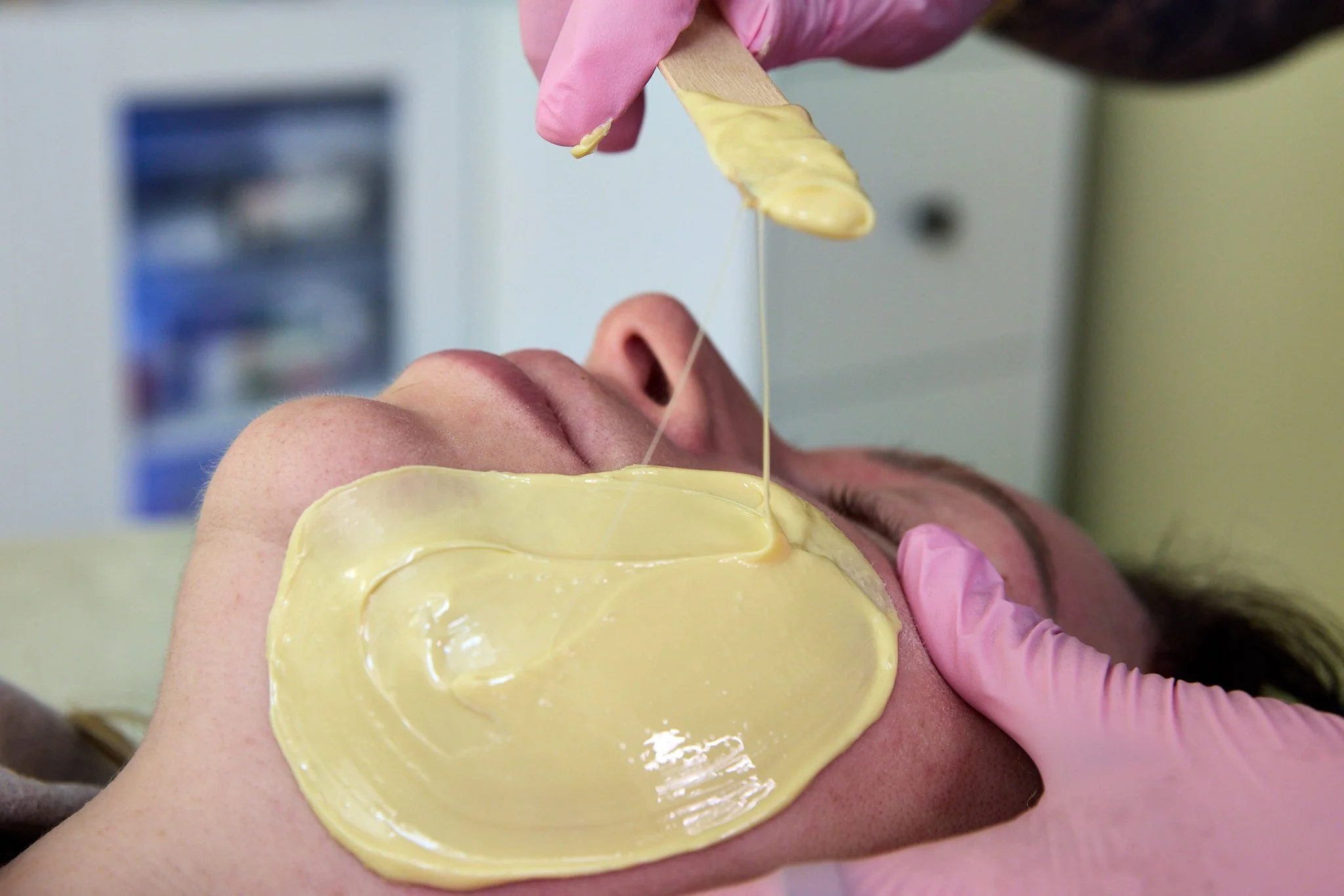 Freshly applied wax on a client's face for hair removal.