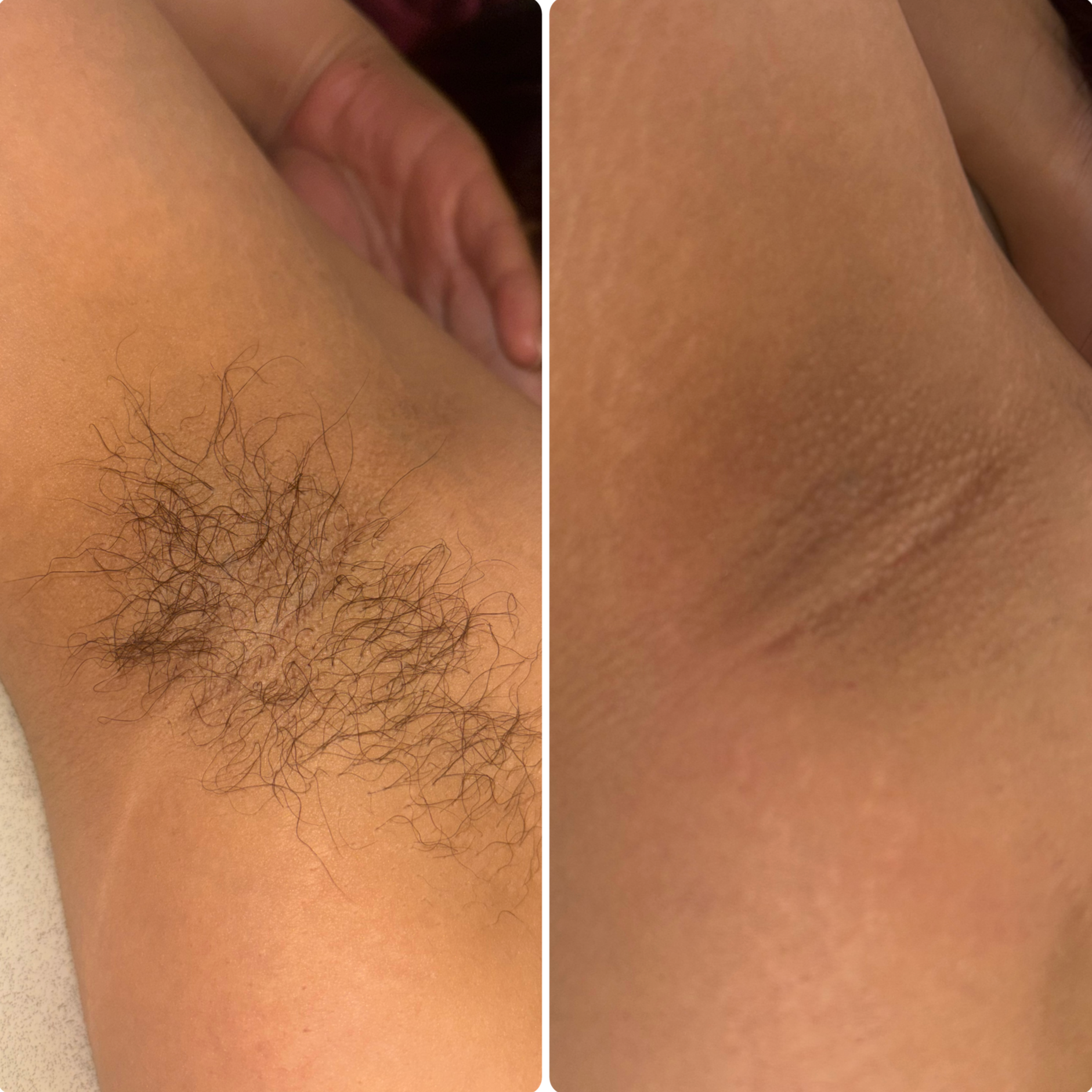Before and after hair removal on a client's underarm