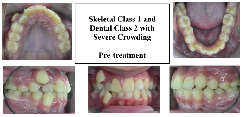 CASE 2: PRE-treatment