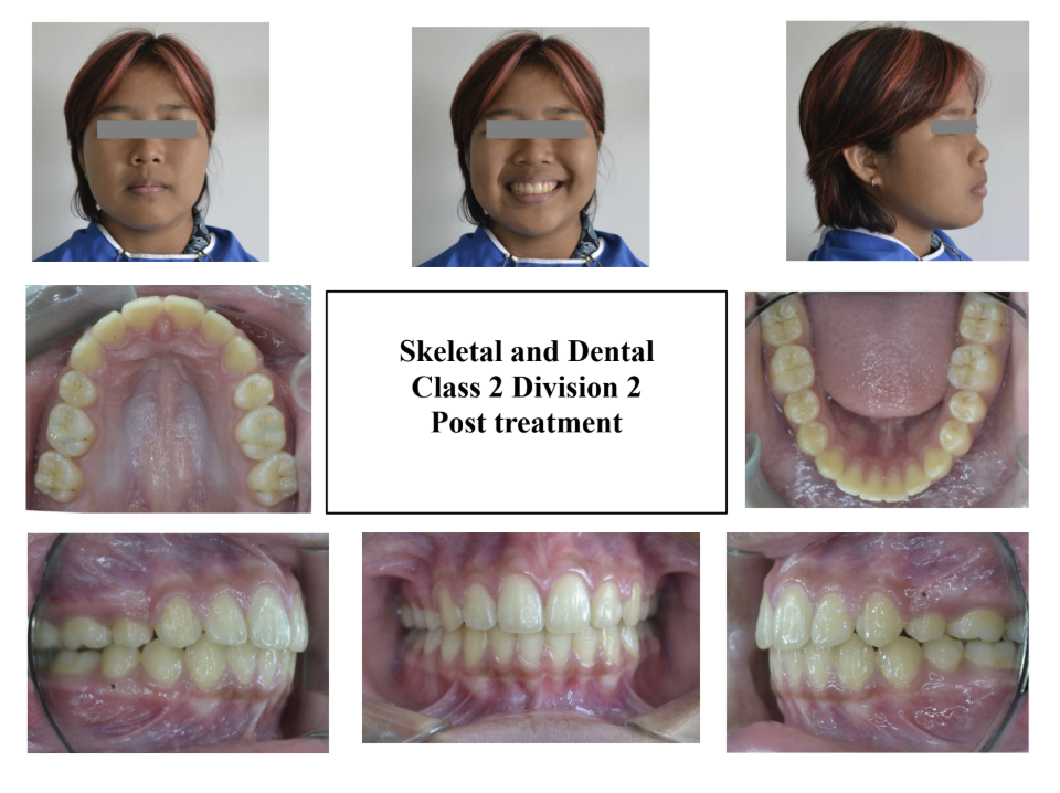 CASE 1: POST-treatment