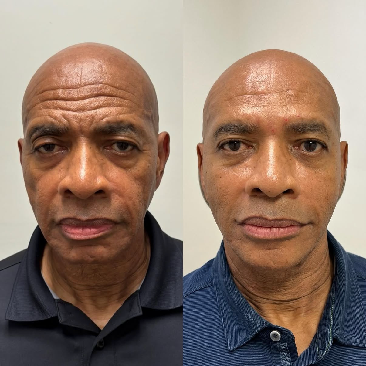 Before and after images of a bald man with a neutral expression, showing improvement in skin condition, wearing a black polo shirt in the first image and a blue dress shirt in the second.