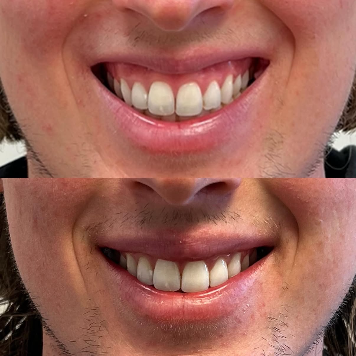 Close-up of smiling person's mouth, showing teeth and gums in a before and after comparison.