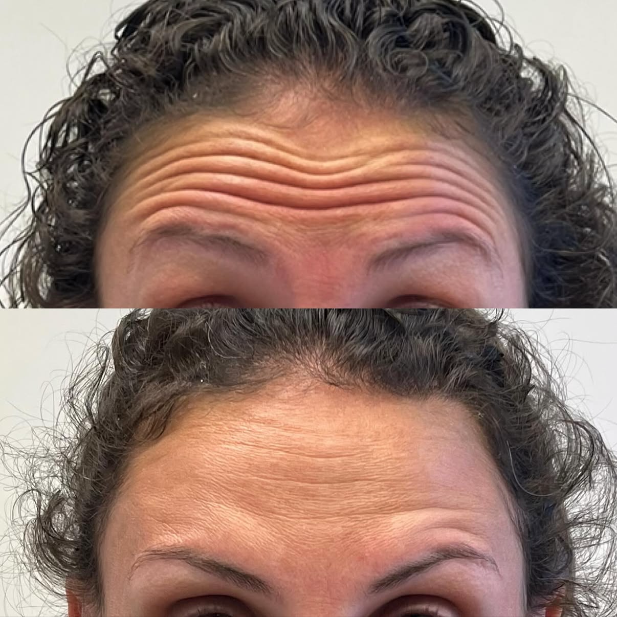 Comparison of forehead wrinkles before and after treatment, showing fewer wrinkles in the after image.