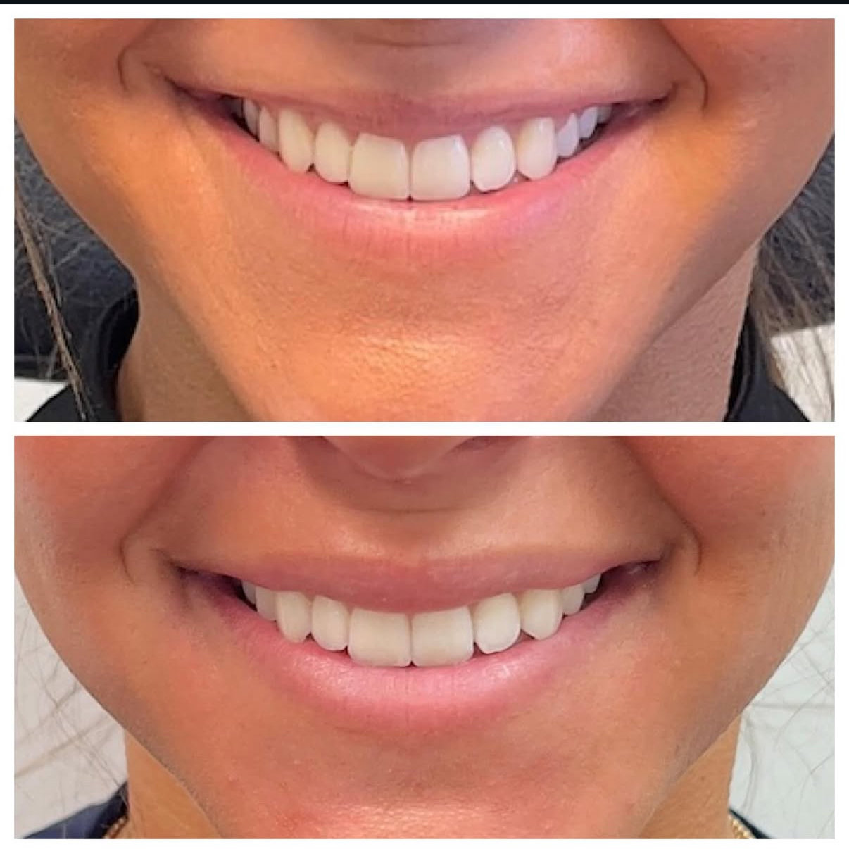Comparison of a person's smile showing before and after teeth whitening.