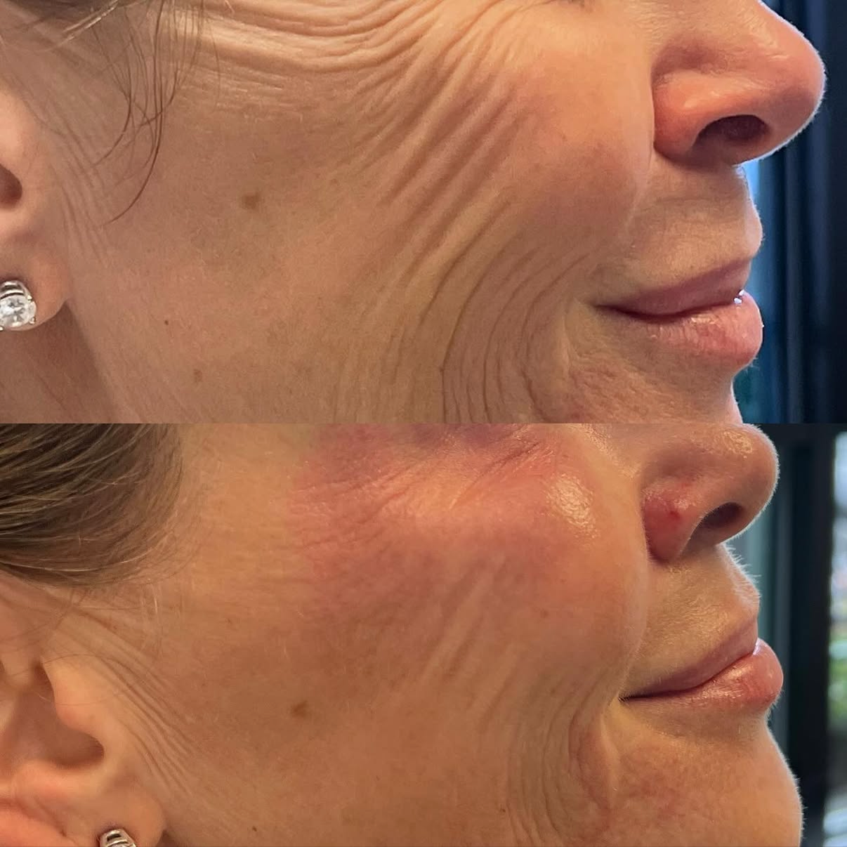 Close-up comparison of a woman's face showing reduction in facial wrinkles and skin texture improvement, especially around the cheek and mouth area.