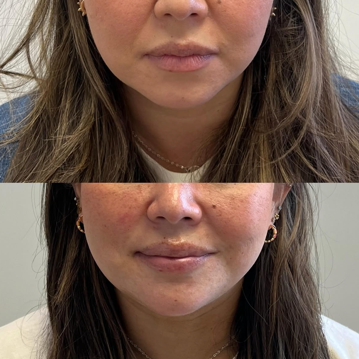 A side-by-side comparison of a woman's face showing before and after skin treatment. The top image shows her with more uneven skin tone and blemishes, while the bottom image shows her with clearer and smoother skin.