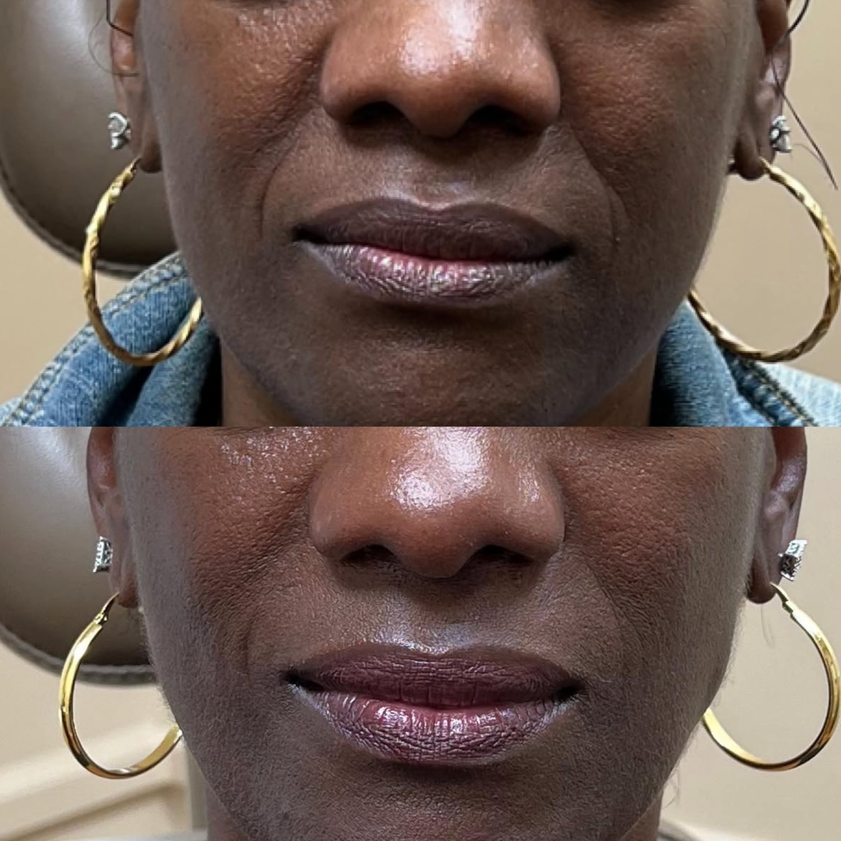 A side-by-side comparison of a woman's face showing before and after close-up shots of her lips, with earrings and skin texture visible.