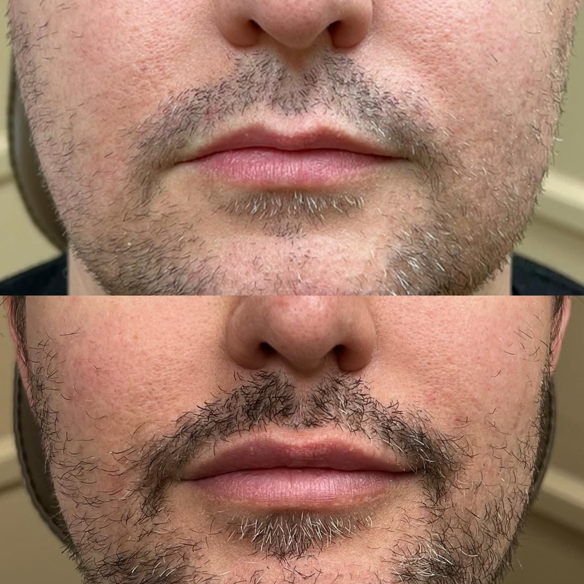 Close-up of a man's lips and beard, showing before and after comparison of beard grooming.