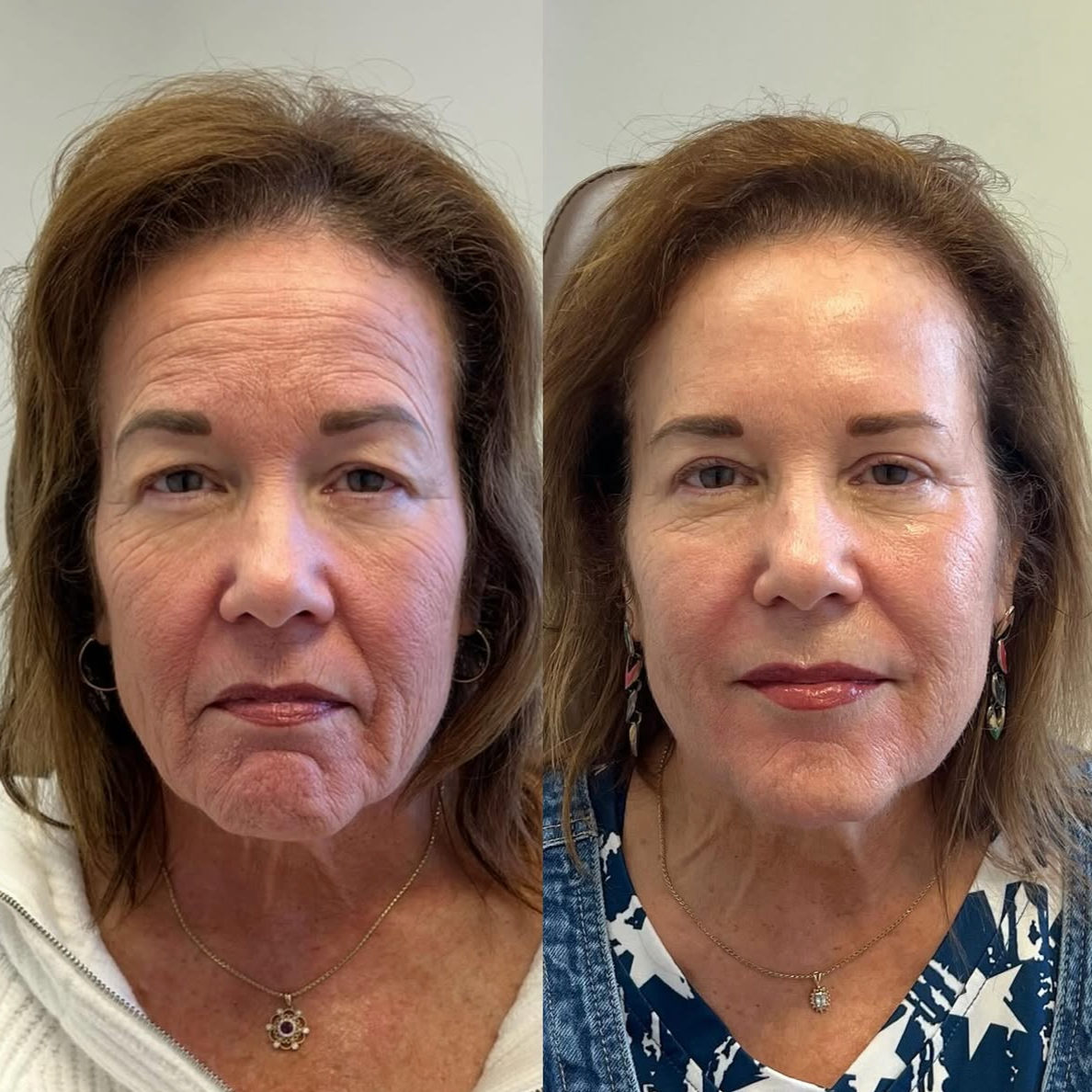 Side-by-side comparison of a woman before and after cosmetic treatment, showing youthful skin, fewer wrinkles, and improved facial appearance.