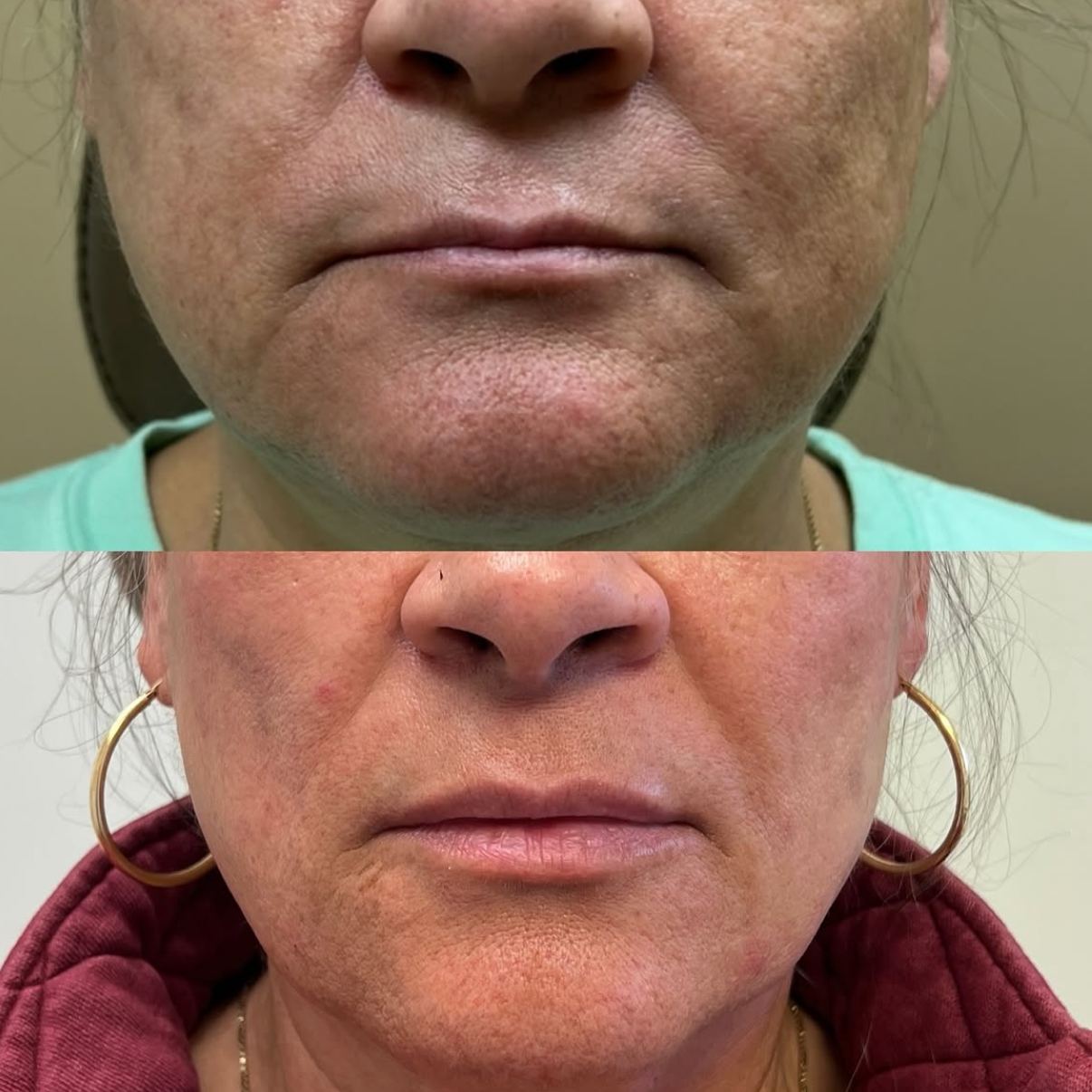 Before and after close-up photos of a woman's lower face, showing skin improvement and reduced wrinkles with visible earrings and different clothing.