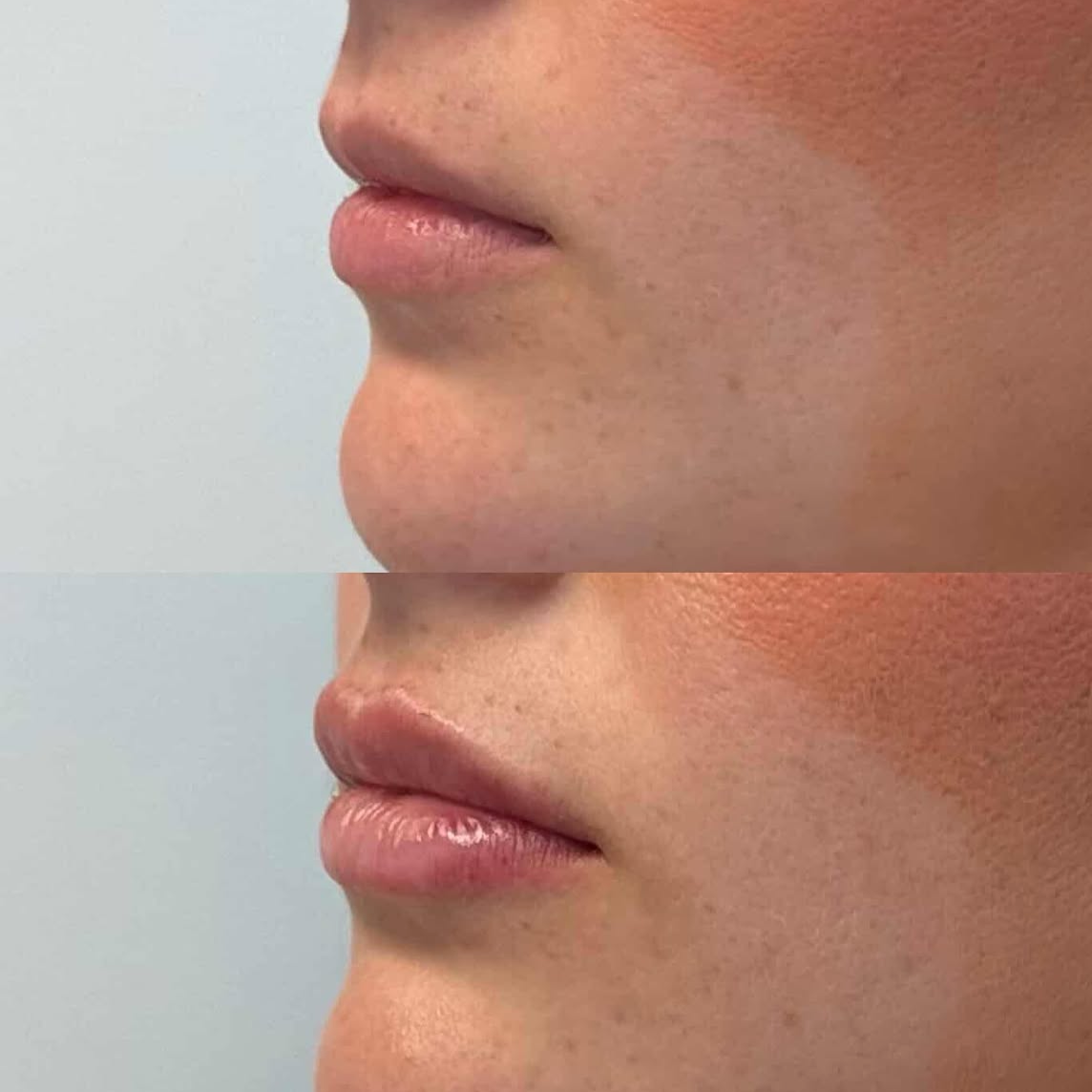 Before and after close-up of lips and chin, showing cosmetic improvement with smoother skin and fuller lips in the after photo.